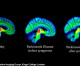 Hope for Parkinson’s as scientists spot signs of the cruel disorder in the brain YEARS before patients show any of the traditional symptoms Hope for Parkinson’s as scientists spot signs of the cruel disorder in the brain YEARS before patients show any of the traditional symptoms