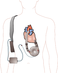 230px-Ventricular_assist_device
